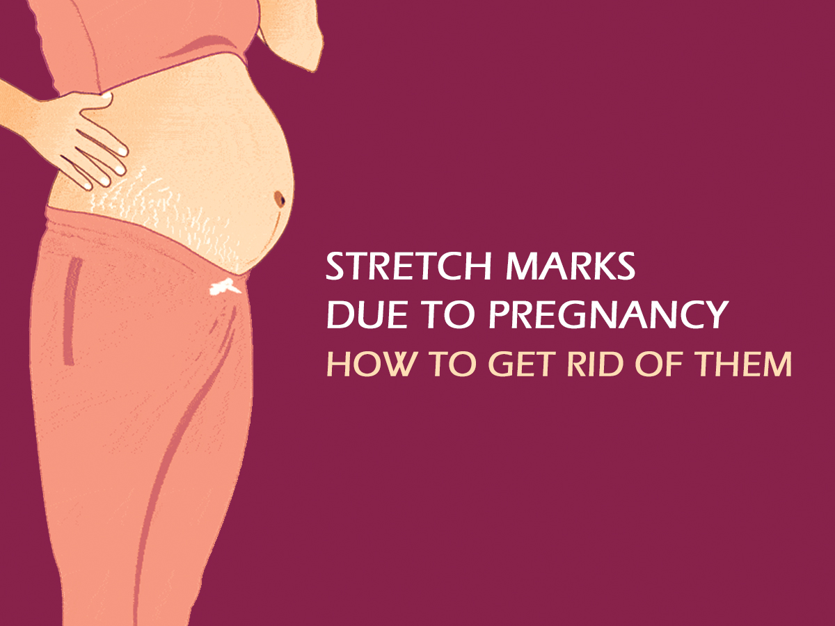 Getting Rid Of Pregnancy Stretch Marks Fernandez Hospital 