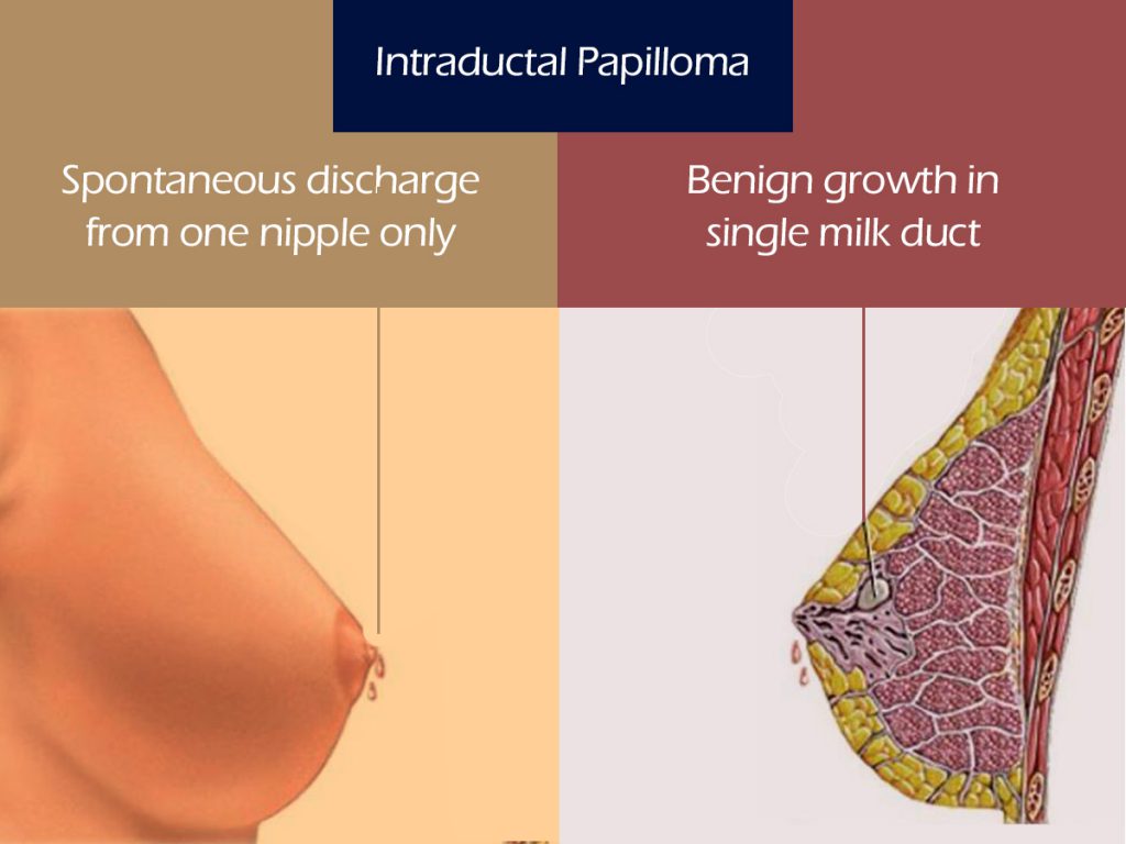 Nipple discharge: Causes and treatments